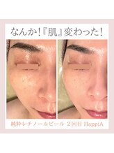 ハピア(HappiA)/純粋レチノールピール