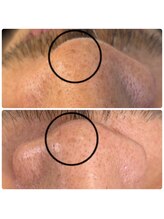 バイカラー(BY COLOR)/【ハイドラ毛穴洗浄】