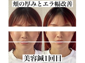 ヒールジョイ(HEAL JOY)/一回でもかなりの変化