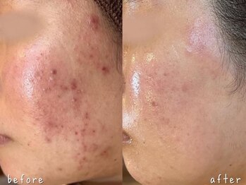 エヌエースキン たまプラーザ店(NAskin)/ハーブピーリング|ニキビケア