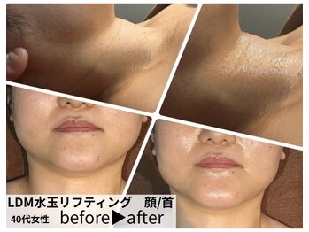 サロンスペース/韓国LDM水玉リフティング 顔+首