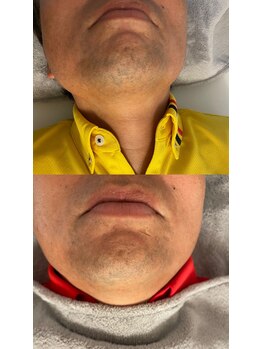 セルカ(CELCA)/メンズヒゲbefore after