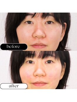 つつじが丘整骨院鍼灸マッサージ院/美容鍼　Before After