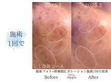 ディアスマイル(Dear.smile)/施術1回で