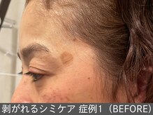 オアシスラグーン(OASIS LAGOON)/シミケア（症例1 before）50代