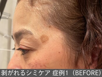 オアシスラグーン(OASIS LAGOON)/シミケア(症例1 before)50代