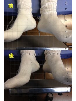 アトラス ストレートカイロプラクティック/足の長さのチェック