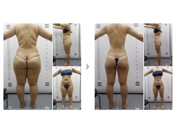 Nビューティー/最新エンダモロジーBODY