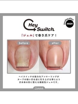 ネイリュー(naiLiu)/巻き爪矯正