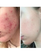 クールグラシュー(couer gracieux) 【6】 美肌効果