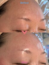 リュウ鍼灸院 サロン ド リュウ(Salon de Ryu)/高濃度水素パック