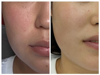 ラミーユ(La Miu)/【ハーブピーリング】