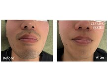 アットイカウ 下北沢(at ikaw)/全顔スッキリ脱毛 Before/After 