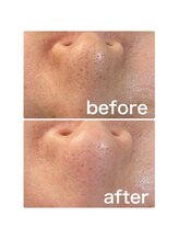 ゴールデンケア(goldencare)/毛穴　変化