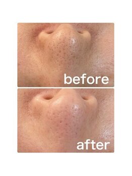 ゴールデンケア(goldencare)/毛穴 変化