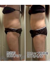 クールスパ(COOL SPA)/50代女性 お腹症例