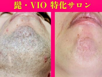 フォレスト 四日市/☆髭脱毛専門店☆