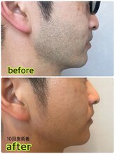 ソウ(SOU)/メンズ　ヒゲ脱毛