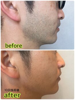 ソウ(SOU)/メンズ　ヒゲ脱毛