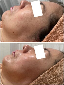 リッツ 所沢店/【Before/After】たるみ改善