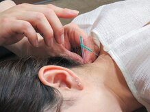 だるま整骨院/鍼灸はお任せください