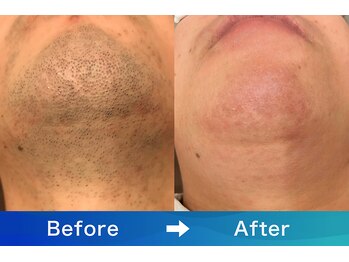 アリッサムフォーメン 岡山店(ALiSSUM for men)/アフター保証ご利用のお客様