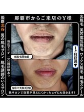 メンズディースタイル 北谷店(Men's Dstyle)/北谷メンズ脱毛ヒゲBefore after