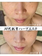 サロン ド エン(Salon de. en)/ニキビケア◇ハーブピーリング