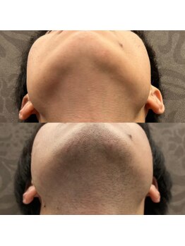 フェリーバ(FELIVA)/Before&After