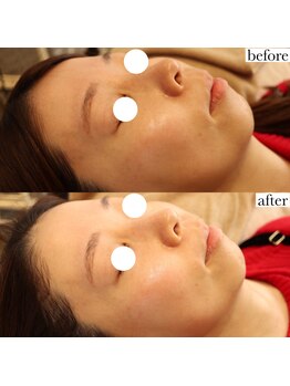 メゾリーナ(MAISOReNA)/水光ピール&エクソソーム