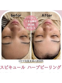 マヴィ 高槻店(MavY.)/剥離なしハーブピーリング