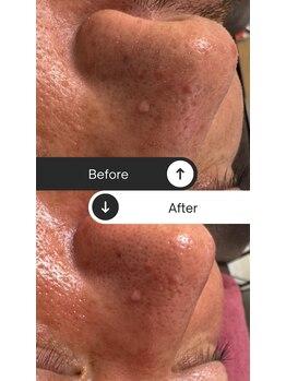 サロン オ レヴィア(SALON.O.REVIA)/水素毛穴洗浄