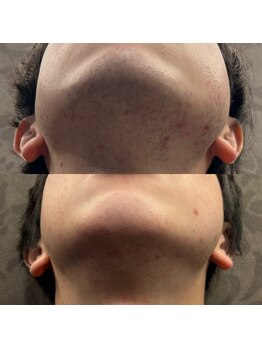 フェリーバ(FELIVA)/Before&After