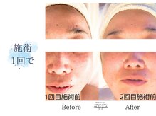 ディアスマイル(Dear.smile)/施術1回で