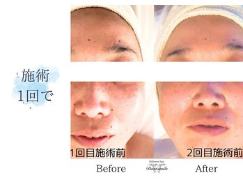 ディアスマイル(Dear.smile)/施術1回で