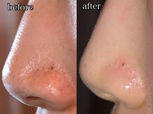 コム(comme39)/毛穴黒ずみ解消？！☆