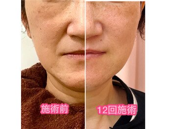 ベストシーン エルシティ新浦安七番館店/Dr.アリーヴォ　12回施術後