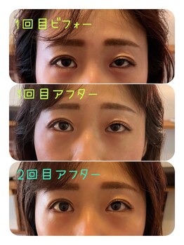 はぐれフルヤ/小顔施術結果