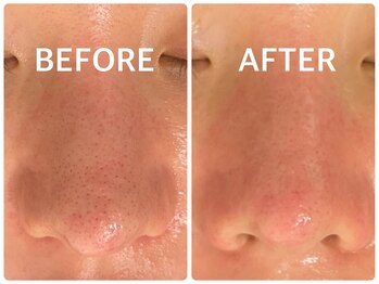 ハーブピーリング 恵比寿/小鼻毛穴引締めハーブピーリング