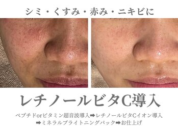エクラ イオンモール徳島店(ECLAT)/超音波導入+イオン導入