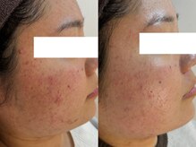 ベェル(Belle)/ ハーブピーリングBeforeAfter