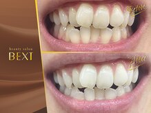 ベクスト(BEXT)/セルフホワイトニング