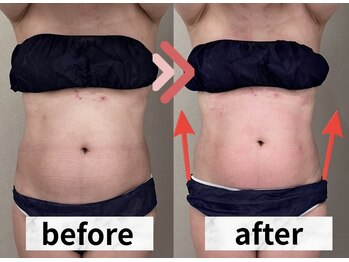 イヨヨ(iyoyo)/【痩身】Before After