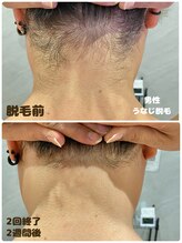 ワイズサロン(Y's salon)/男性うなじ脱毛