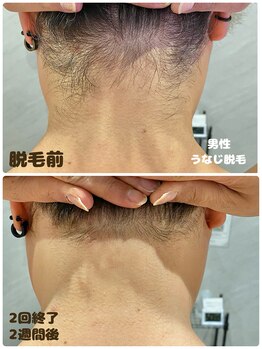 ワイズサロン(Y's salon)/男性うなじ脱毛