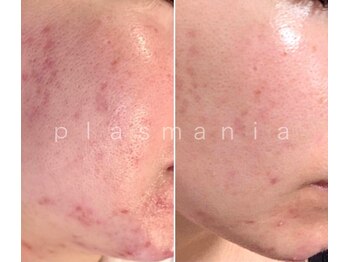 イノエ(inoe)/【繰り返すニキビ・毛穴悩みに】