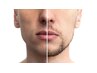U25メンズひげ脱毛 ¥2500