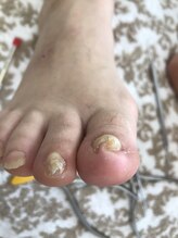 足のケア アンド 巻き爪 エムズ 白金通り店(M's)/巻き爪矯正1