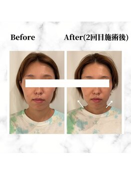 ザビューティー 麻布十番本店(The Beauty)/12Dリフト全顔打ち放題[リフト]