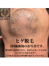 リーペックス(LEAPEX)/ヒゲ脱毛